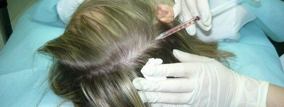 30033777-mezoterapiya-hair-oti