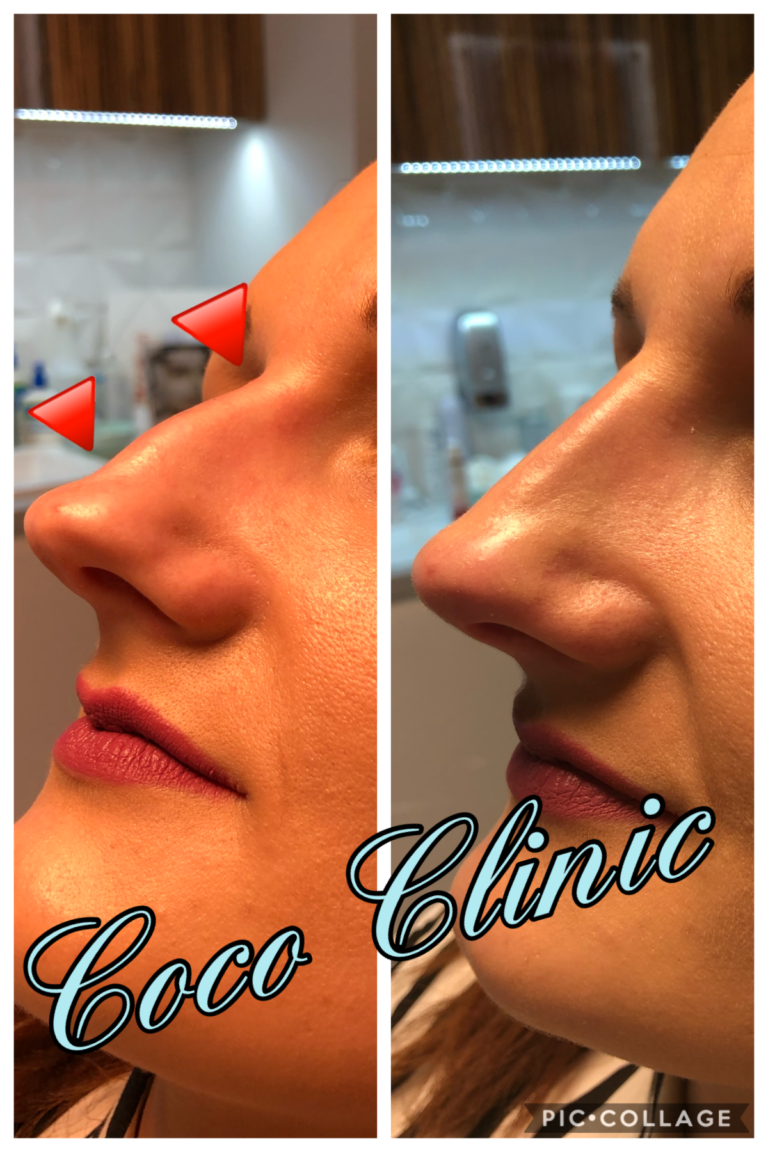 Modelowanie Nosa Śląsk Korekcja Nosa Śląsk Coco Clinic 5094